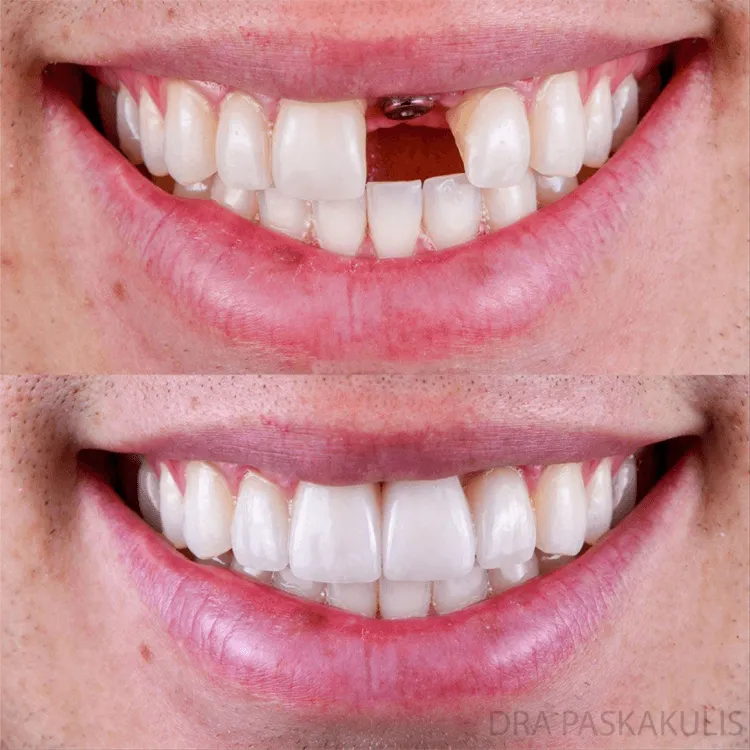 Antes e depois implante dentário