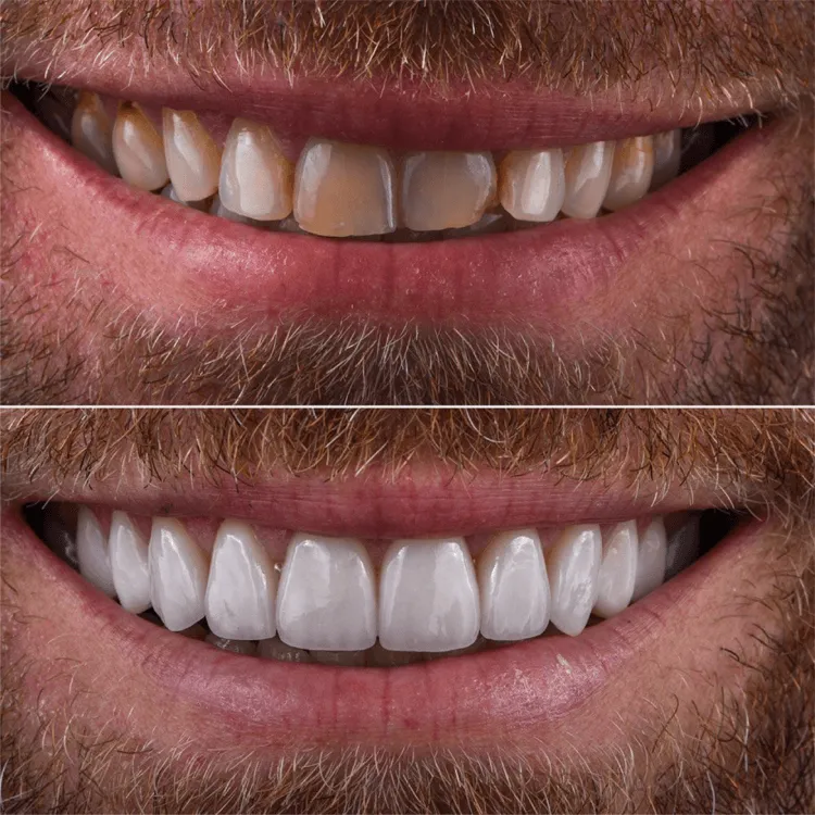 Antes e depois lentes de contato dental 2