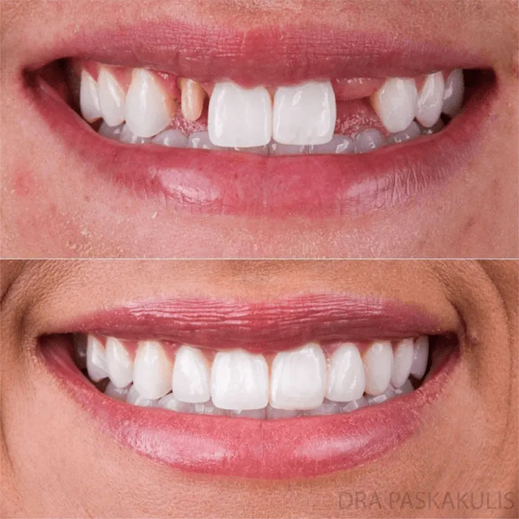 Antes e depois lentes de contato dental