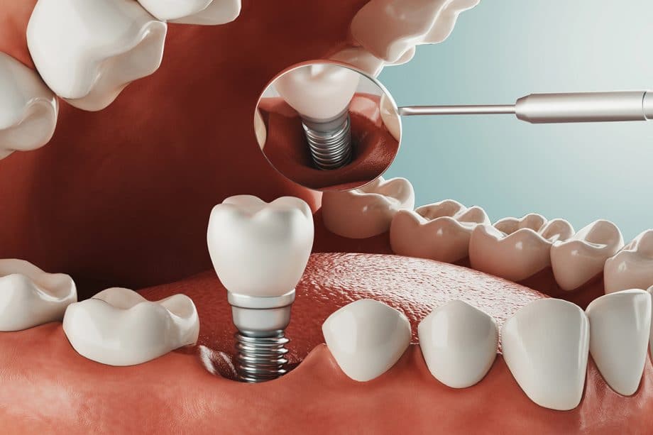 implante dentario em jundiai