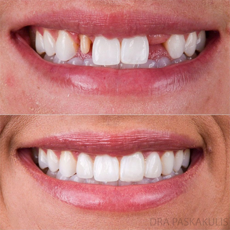 lente de contato dental antes depois